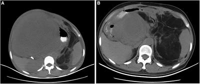 Survival of a patient with multiple-recurrent giant retroperitoneal dedifferentiated liposarcoma for 15 years: A case report